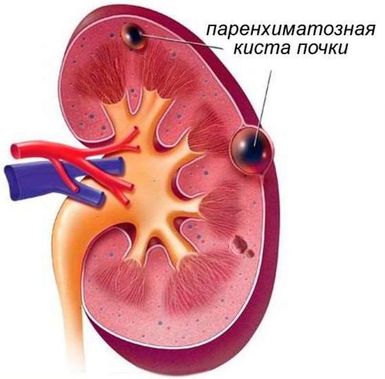 Парапельвикальные кисты почек