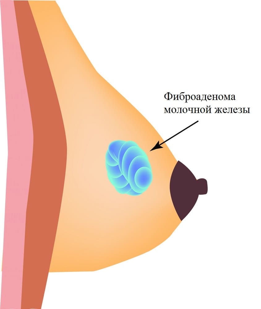 Фиброаденома молочной железы ⋆ oncolog.kiev.ua