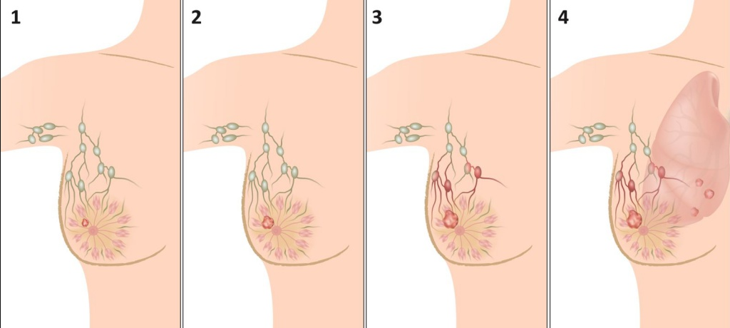 рак молочной железы стадия