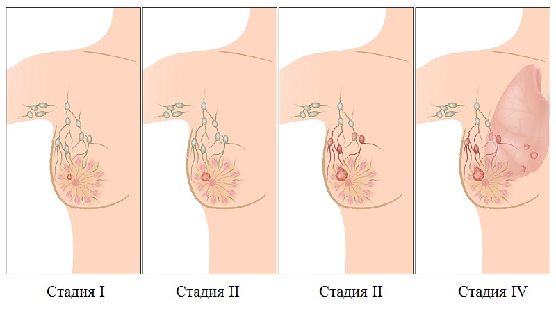 Рак молочной железы 1 стадии
